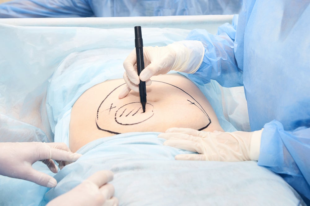 What parts are removed during a hysterectomy? What is removed during