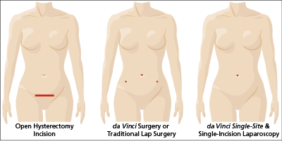 diagram of hysterectomy incisions