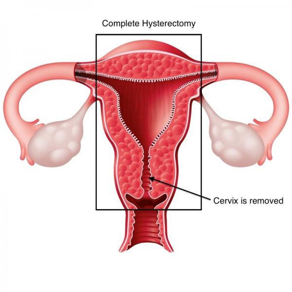 Complete hysterectomy